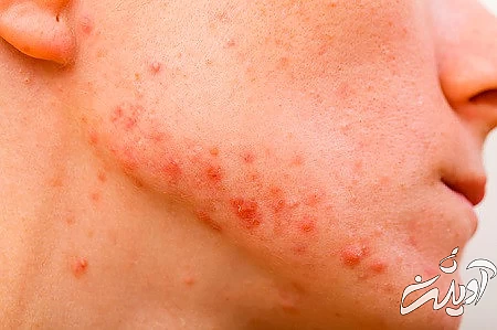 یکی از نشانه های کمبود مواد مغذی آکنه می باشد خشکی پوست ناشی از کمبودهای تغذیه ای ,آکنه صورت